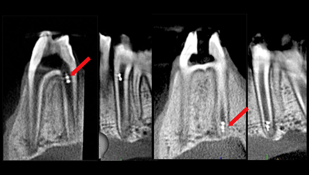 Broken Tooth Repair  Penn Dental Medicine