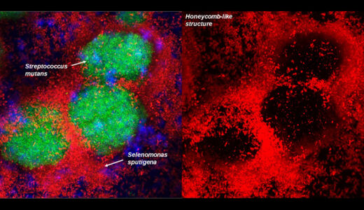 Koo Lab, Collaborators Identify a New Bacterial Species Involved in Tooth Decay