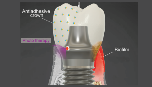 Penn Dental Researcher Receives $2.6M NIH Grant Supporting Development of Next-Gen Dental Implant